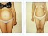 abdominoplastie